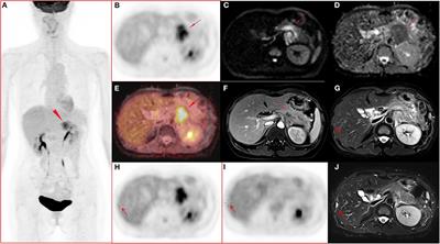 Performance of Multiparametric Functional Imaging and Texture Analysis in Predicting Synchronous Metastatic Disease in Pancreatic Ductal Adenocarcinoma Patients by Hybrid PET/MR: Initial Experience